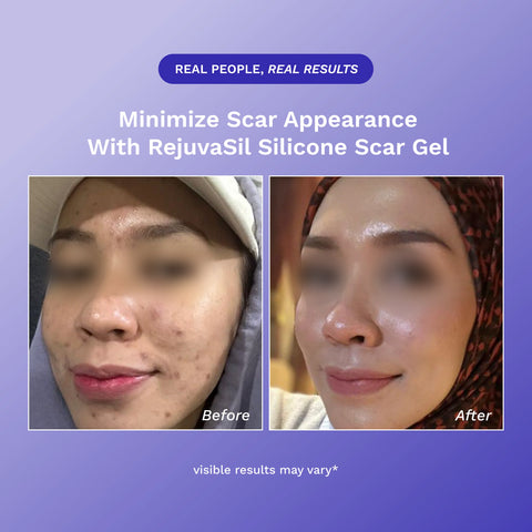 RejûvaSil Gel de silicona para cicatrices 1 oz