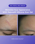 RejûvaSil Silicone Scar Gel 1 oz