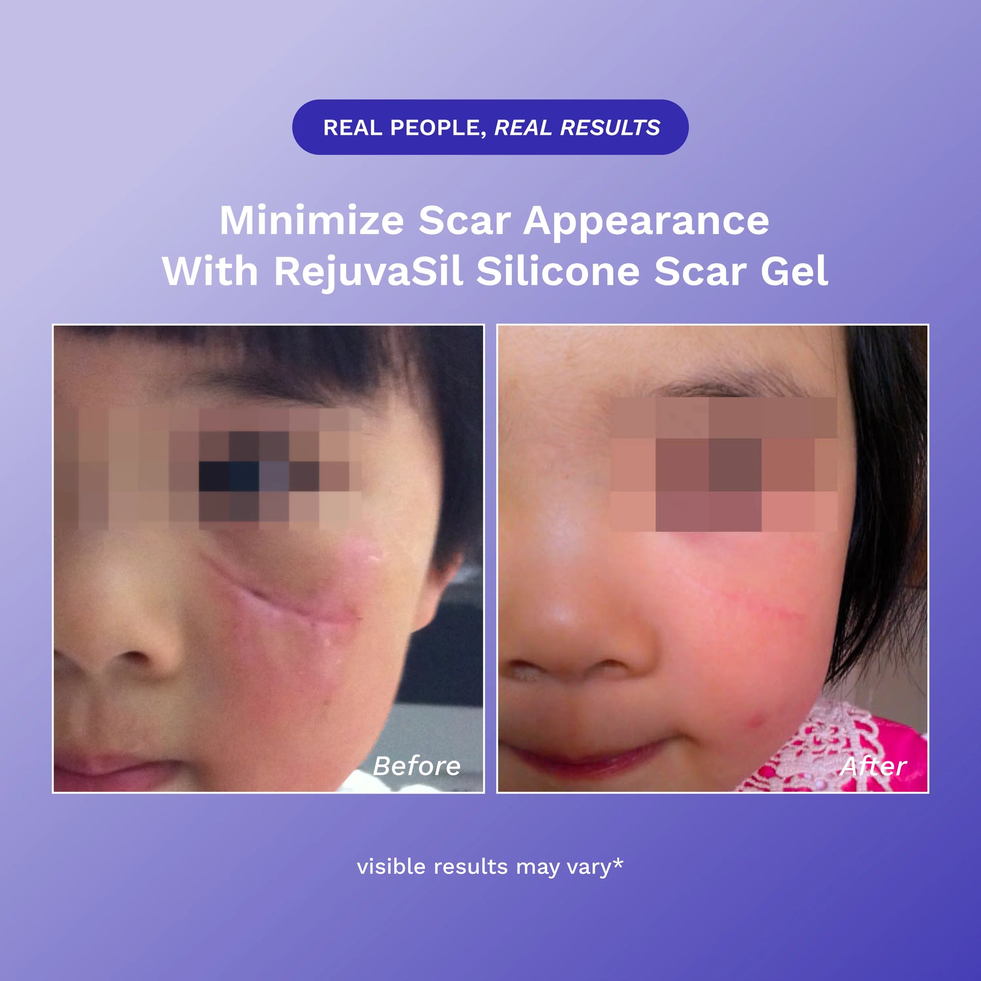 RejûvaSil Silicone Scar Gel 1 oz